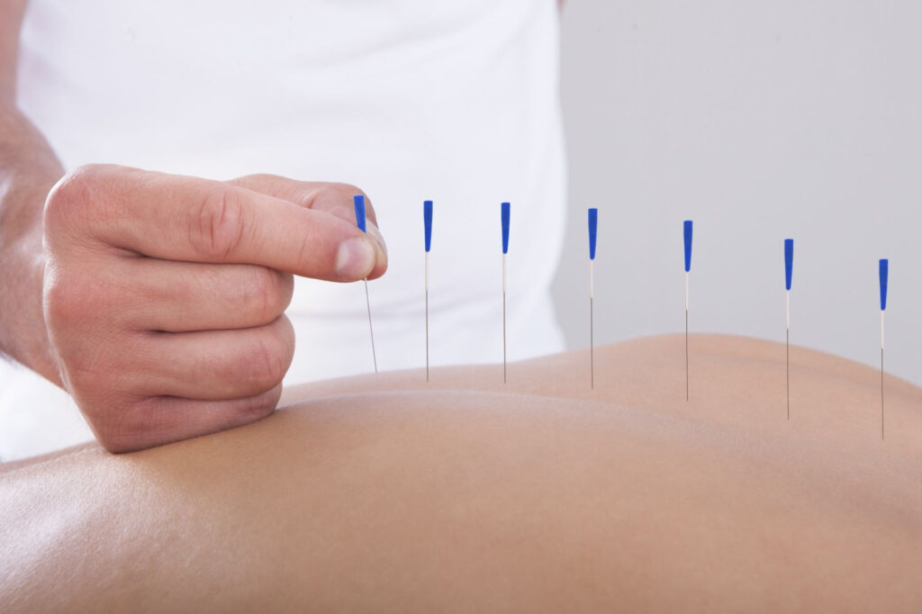 acupuncture calgary south, acupuncture services in calgary, acupuncture in south calgary